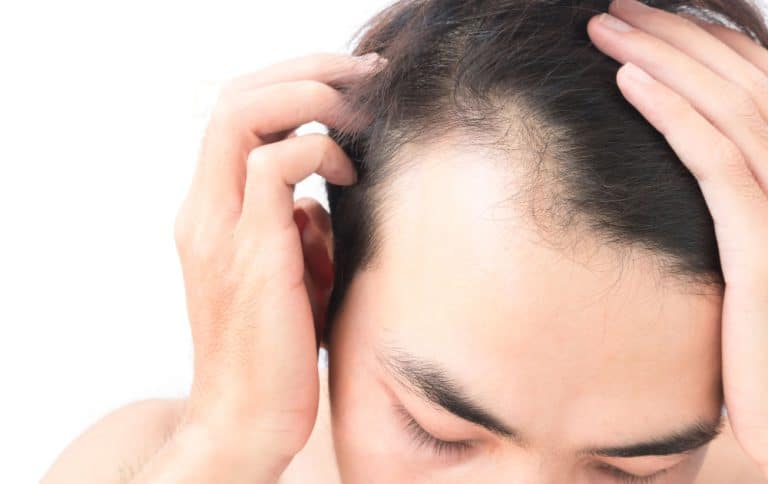 Science-Backed Tips to Handle a Receding Hairline