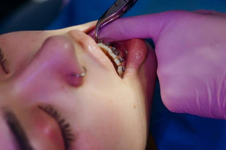 How Often Do Brookhaven Orthodontists Adjust Braces